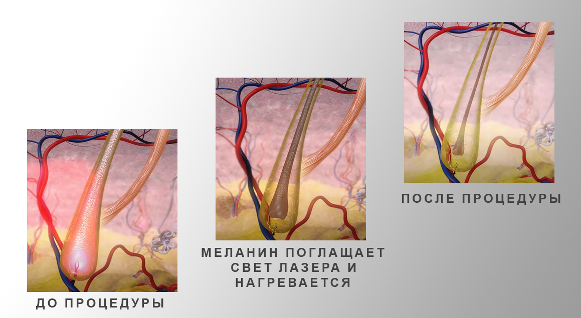 Лазерная эпиляция