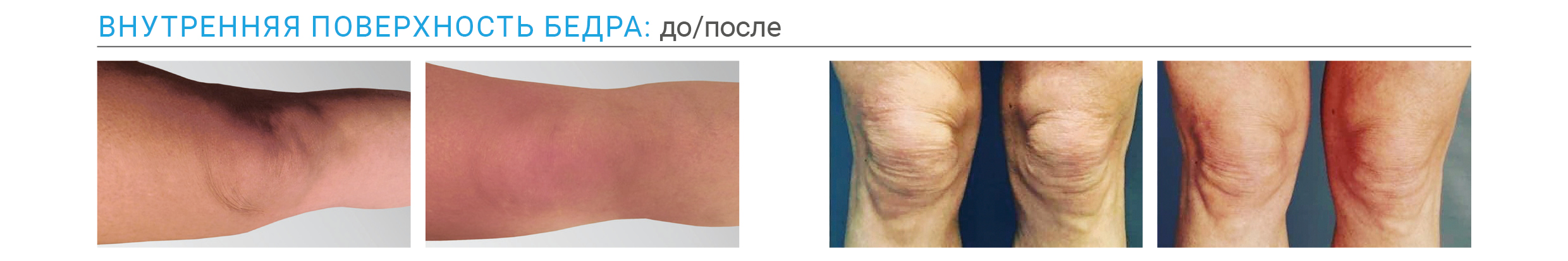 Результаты Endolift до и после