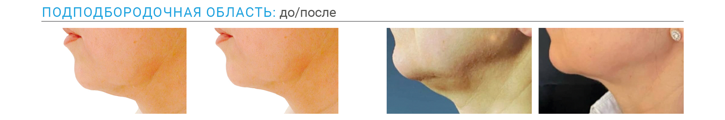 Результаты Endolift до и после