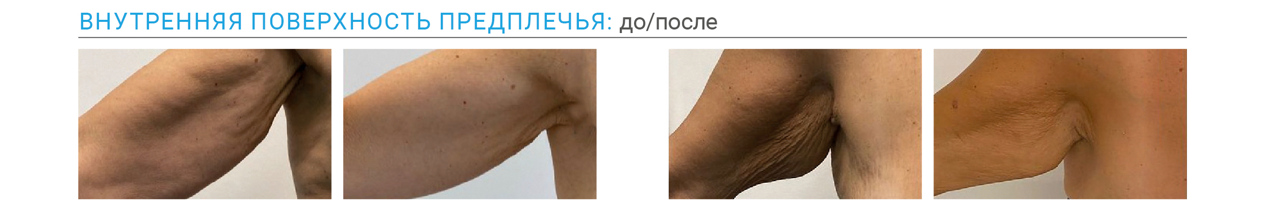 Результаты Endolift до и после