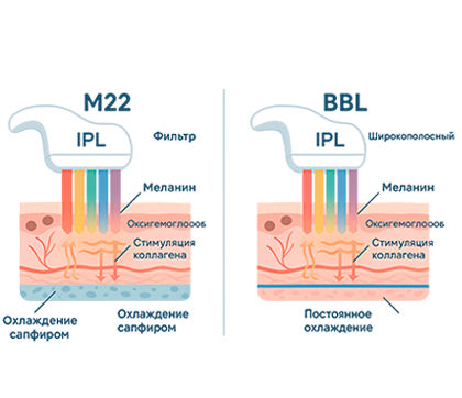 М22 или BBL: что лучше для фотоомоложения лица