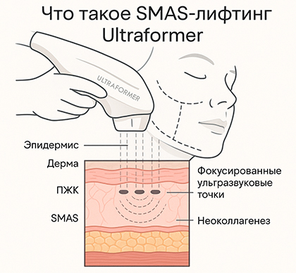 Что такое СMAS/SMAS-лифтинг Ultraformer